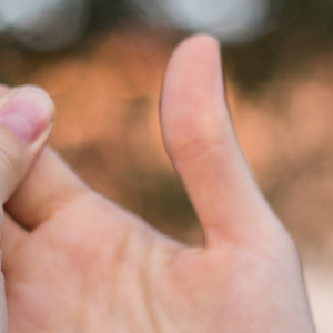 Stem Cells Regrow Lost Finger finger