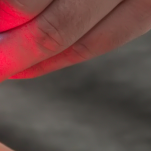 Shine a Light on Back Pain laser-light