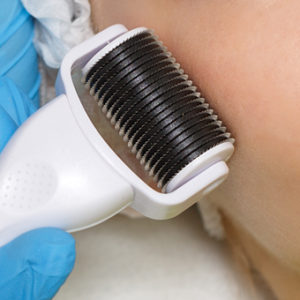Can These Facial Scars Disappear in 15 Minutes? dermaroller